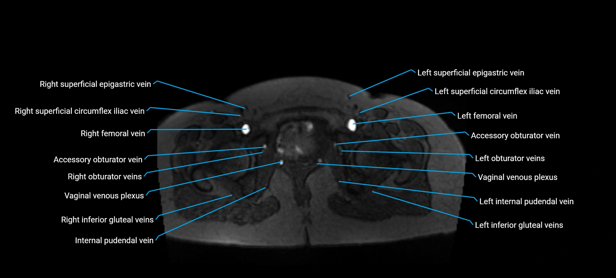 MRV abdomen pelvis & lower limb axial cross sectional anatomy labelled MRI image 186 (1).webp